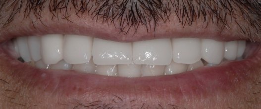 After: Worn, uneven teeth rebuilt across the upper and lower arches