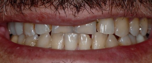 Before: Worn, uneven teeth rebuilt across the upper and lower arches
