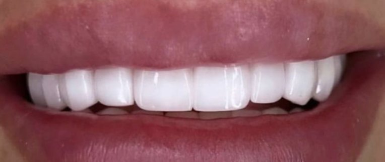 After: Upper arch rebuilt for a brighter, even smile line