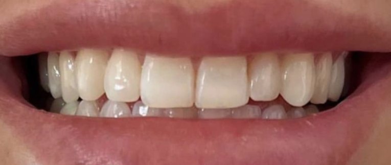 Before: Upper arch rebuilt for a brighter, even smile line