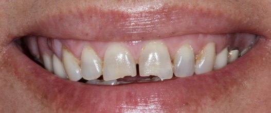 Before: Chipped, uneven teeth restored and the bite recalibrated