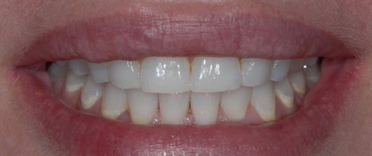 Before: Full mouth rejuvenation with minimally invasive porcelain veneers