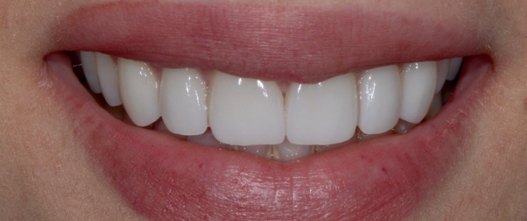 After: 6 upper porcelain veneers