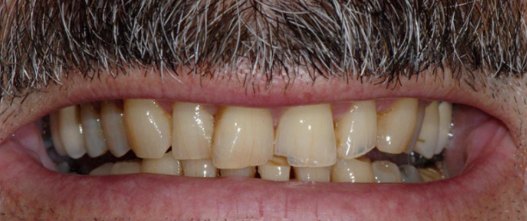 Before: 8 upper porcelain veneers