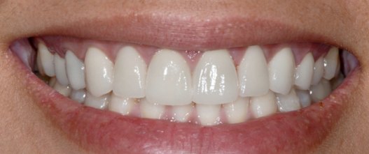 After: 8 upper porcelain veneers