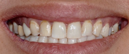 Before: 8 upper porcelain veneers